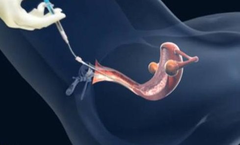 河北生殖妇产医院试管大概多少钱？收费贵吗？